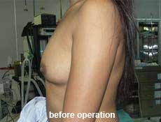 plastic-surgery-breast-augmentation 
